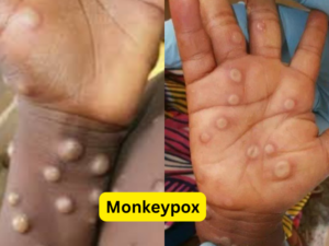 Monkeypox: Symptoms, Treatment, and Vaccine Information